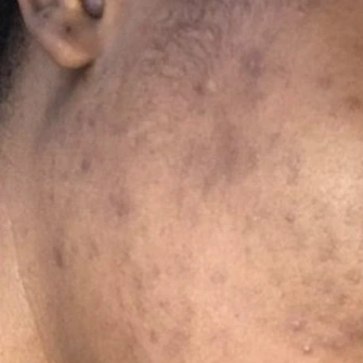 Customer 10: after using Tomato Soap