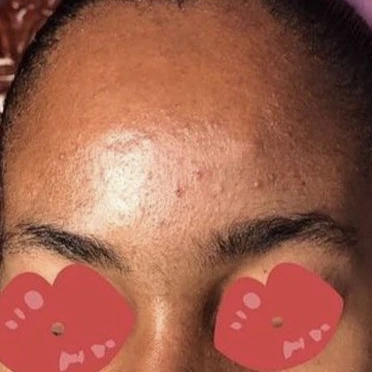 Customer 3: before using Garlic Soap
