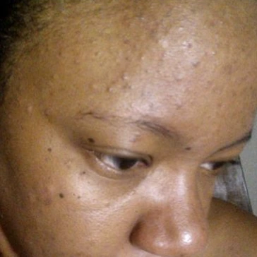 Customer 9: before using Turmeric Plus Soap